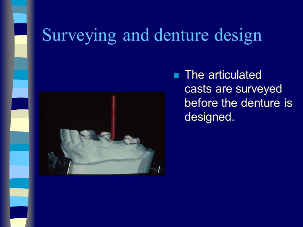 Surveying and denture design The articulated casts are surveyed before the denture is designed.